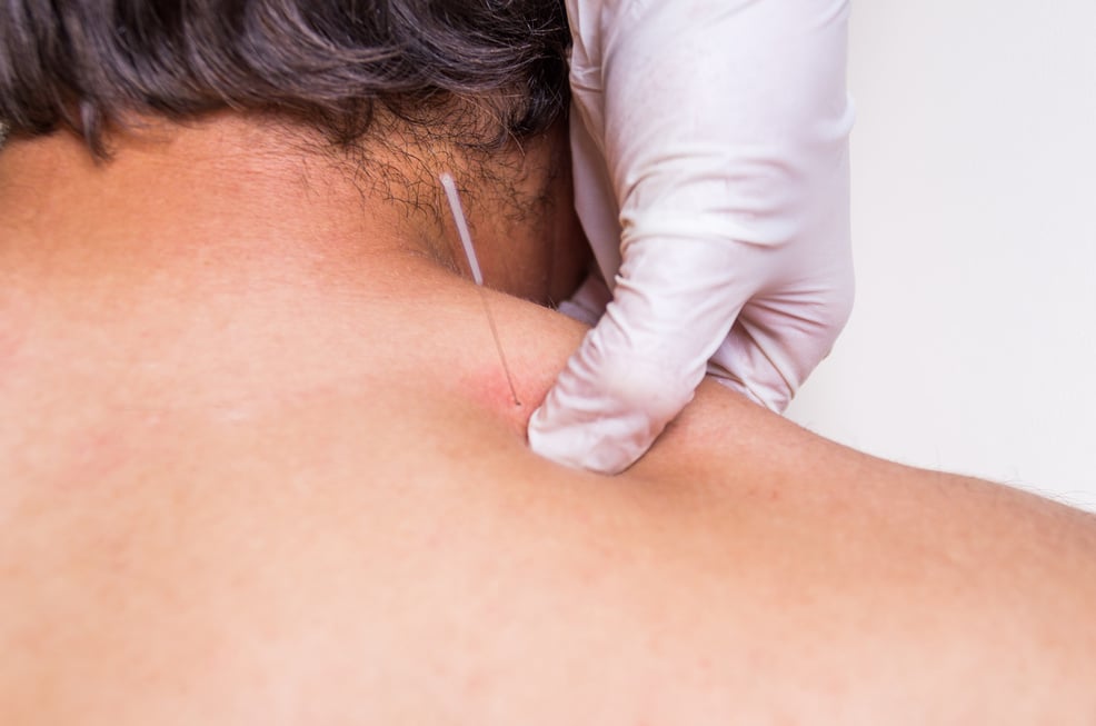 puncion seca dry needling acupunture fisio